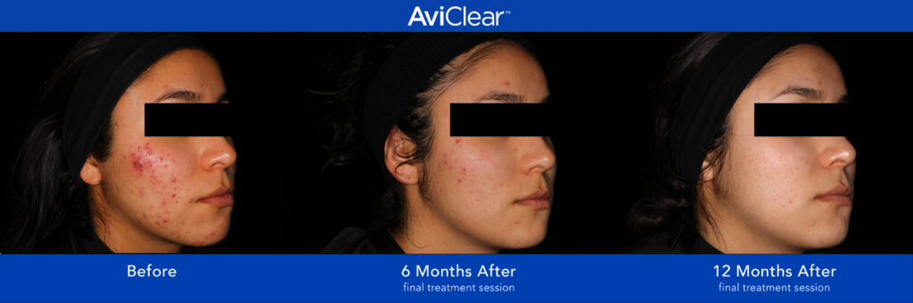 Woman's face with acne before and improvements after 6 and 12 months treatments with AviClear