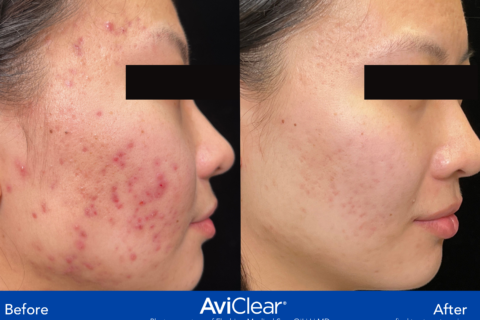 picture of woman's face before and after AviClear treatment