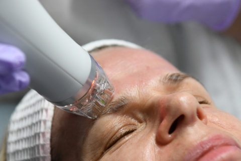 Woman with RF microneedling treatment wand on forehead